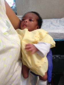 Baby Francesca born without feet because of amniotic bands. 